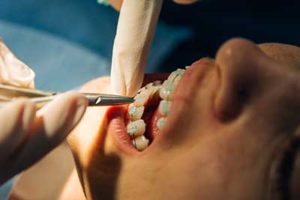 a person getting dental braces tx