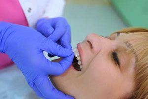 a patient receiving dental veneers tx