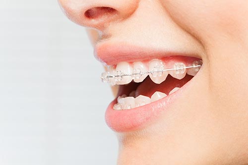 a woman smiling showing options for clear braces northside tx