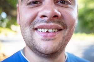 a man in need of dental bonding for chipped teeth northside tx