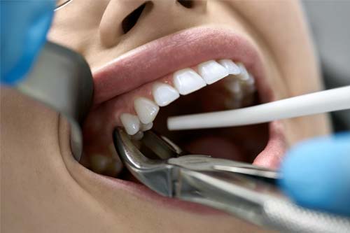 gum recession woman being treated for gum recession