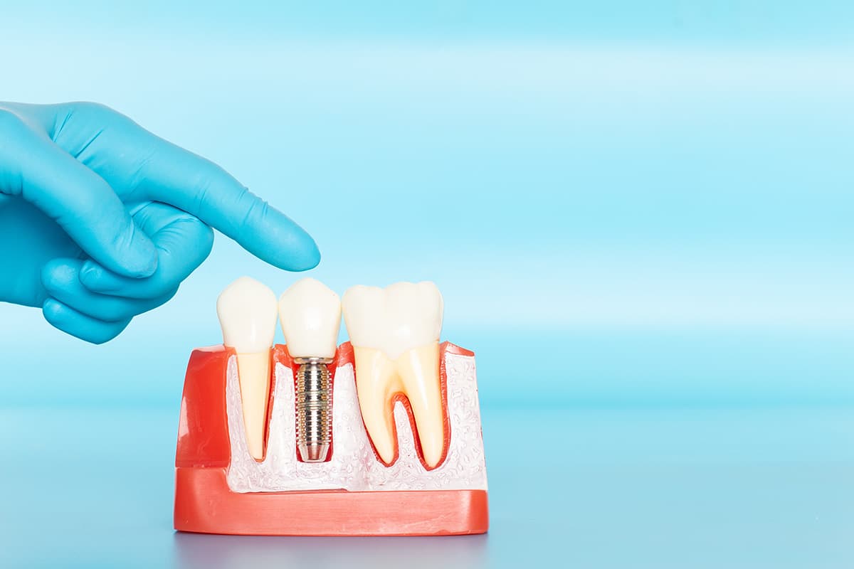 dental implants (1) dental implants in northside, TX