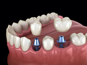 diagram shows the process of implementing dental crowns and bridges 