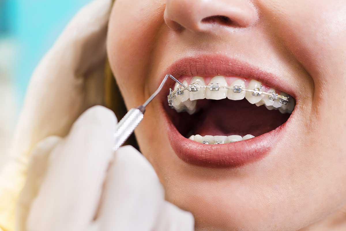 3-Benefits-of-Adult-Orthodontic-Services a woman gets adult orthodontics
