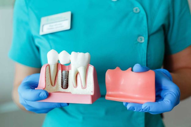 What-is-a-Single-Tooth-Implant- a model represents a single tooth implant