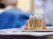 model of dental implants
