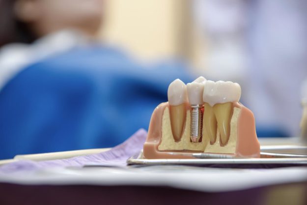 How Do Dental Implants Work (3) model of dental implants