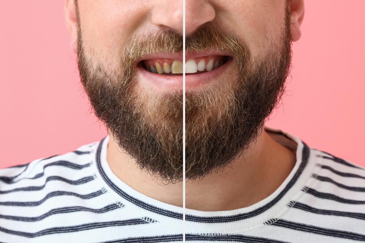 5 Benefits of Dental Veneers (4) man experiencing the benefits of dental veneers